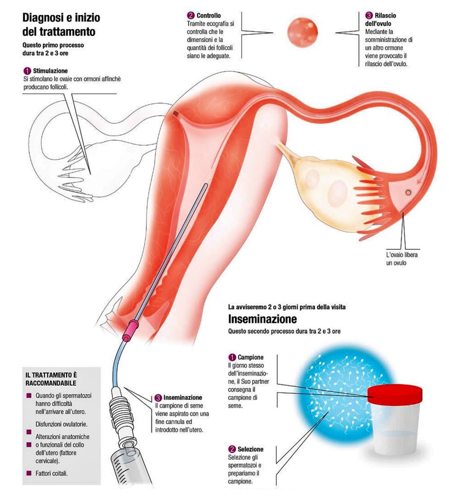 si abbrevia la distanza che separa l’ovulo e lo spermatozoo e si agevola l’incontro tra entrambi i gameti, aumentando le possibilità di conseguire la desiderata gravidanza.